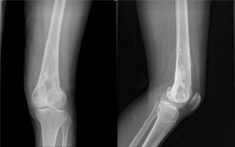 Fibroma desmoplásico en radiografía
