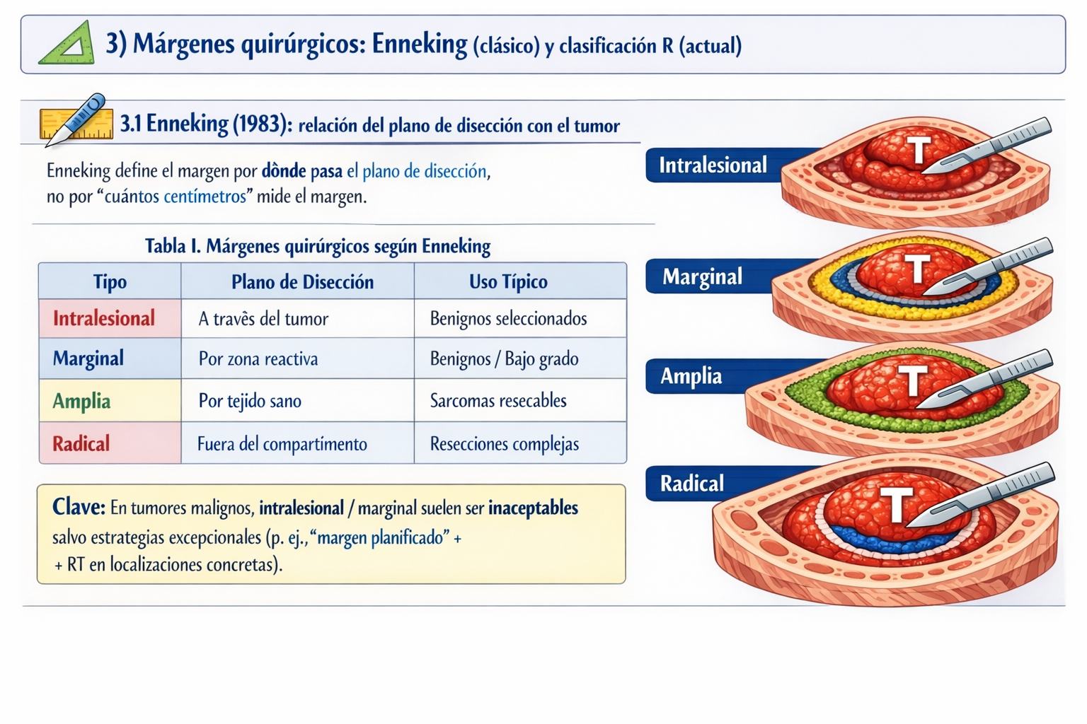 Esquema de márgenes quirúrgicos según Enneking: intralesional, marginal, amplia y radical