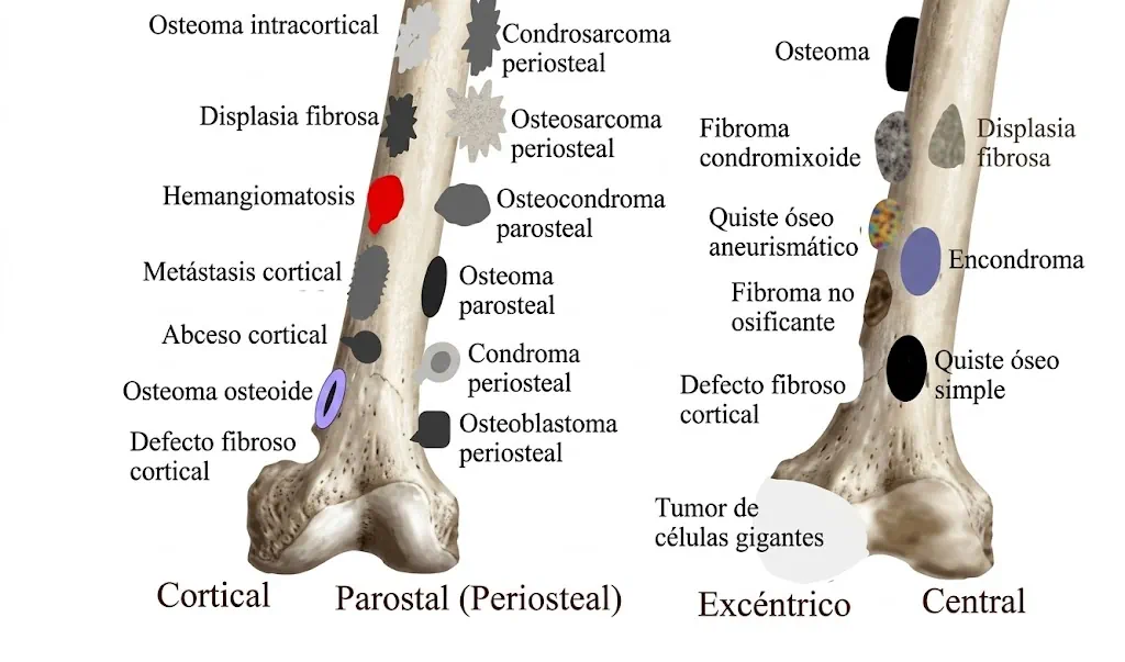 Distribución cortical, parostal, excéntrica y central de tumores óseos