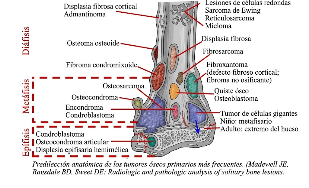 Predilección anatómica de los tumores óseos primarios más frecuentes
