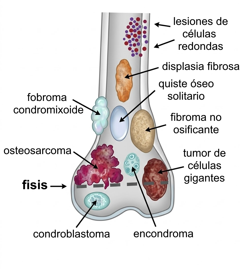 Esquema clásico en hueso largo con fisis y distribución de lesiones