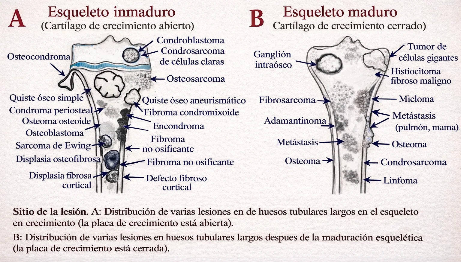 Mapa edad-zona de tumores óseos