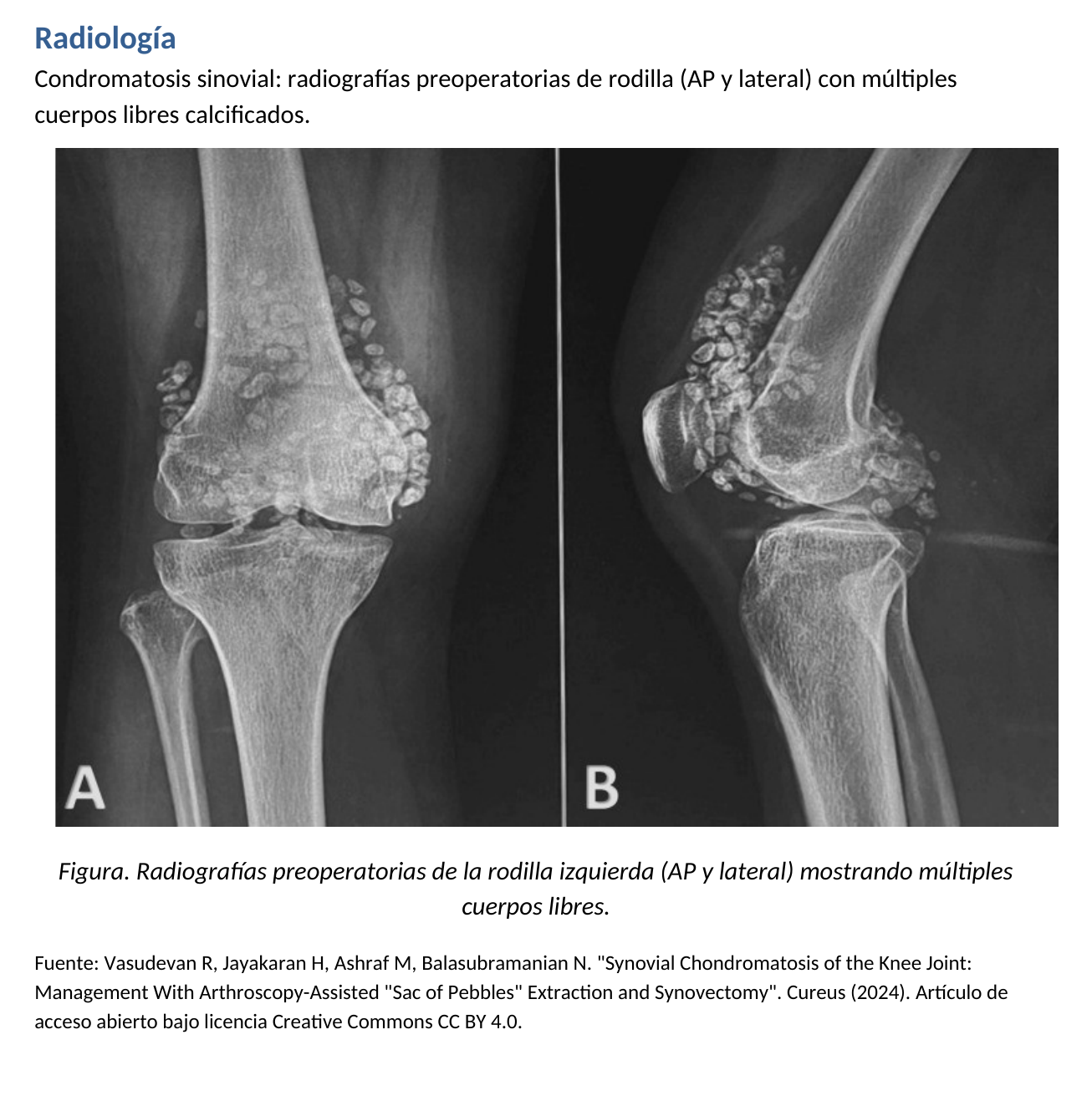 Radiografía: condromatosis sinovial