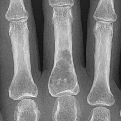 Radiografía de encondroma en falange