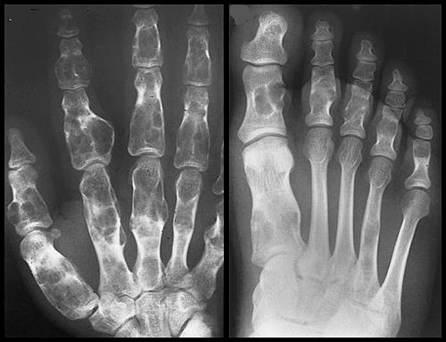 Radiografía de encondromatosis