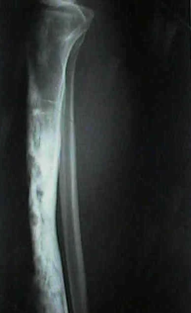 Radiografía de adamantinoma en tibia