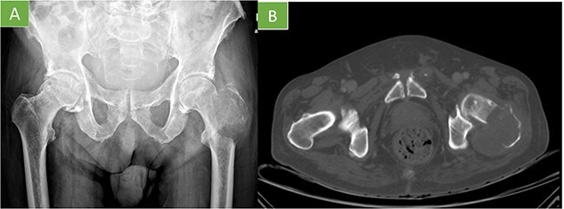 TC axial de angiosarcoma óseo proximal de fémur con lesión lítica y destrucción cortical