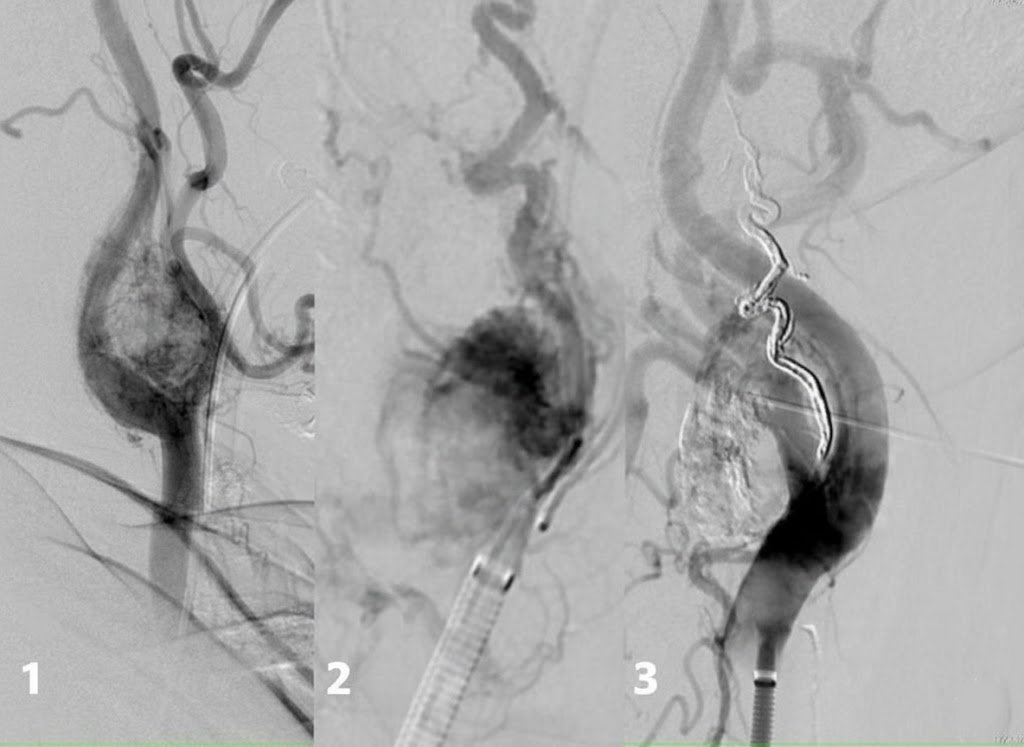 Arteriografía por sustracción digital (DSA)