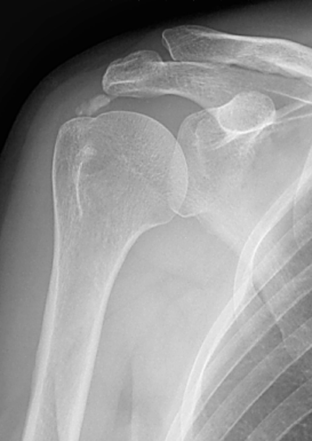 Calcificación periarticular en tendinitis calcificante