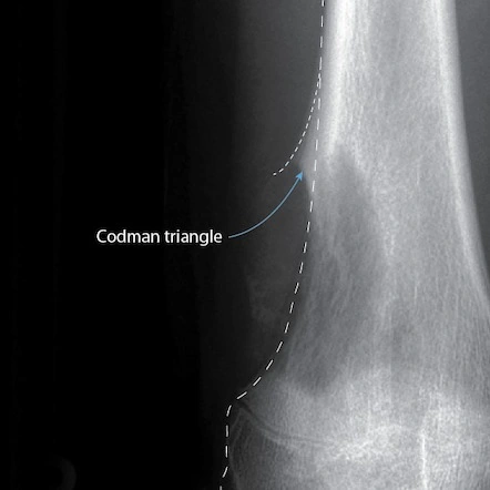Triángulo de Codman en radiografía