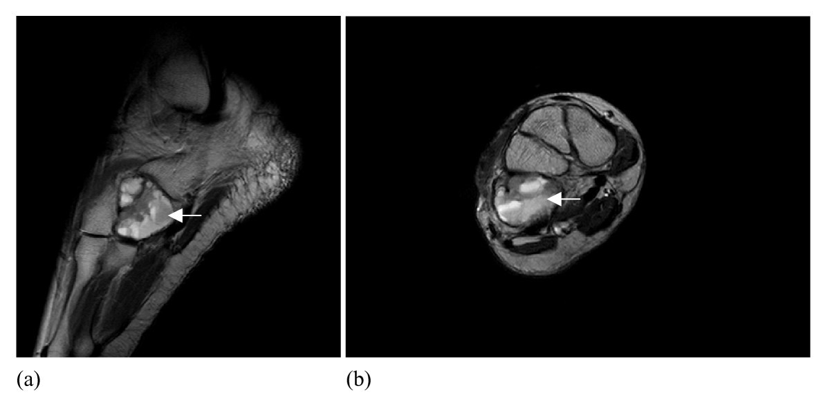 RM de condroblastoma del cuboides con áreas quísticas y niveles líquido-líquido