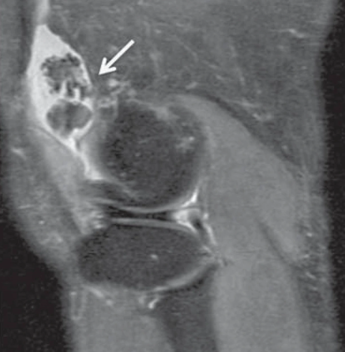 Radiografía de condromatosis sinovial