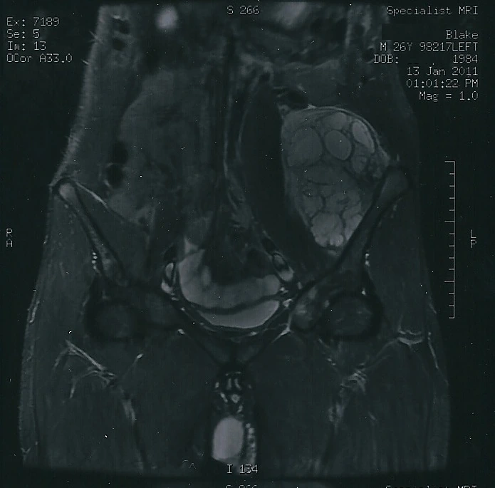 RM de condrosarcoma con extensión medular y de partes blandas