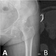 Radiografía de condrosarcoma con calcificaciones condroides