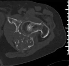 TC de condrosarcoma con calcificaciones condroides y afectación cortical