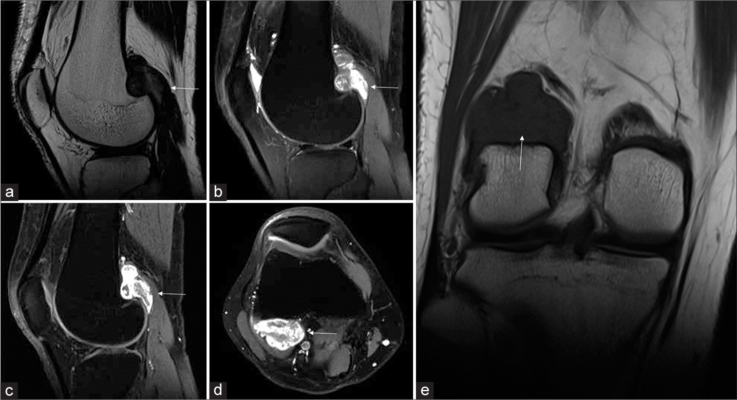 RM de tumor desmoide periostal en rodilla con lesión periostal y scalloping del cóndilo femoral lateral