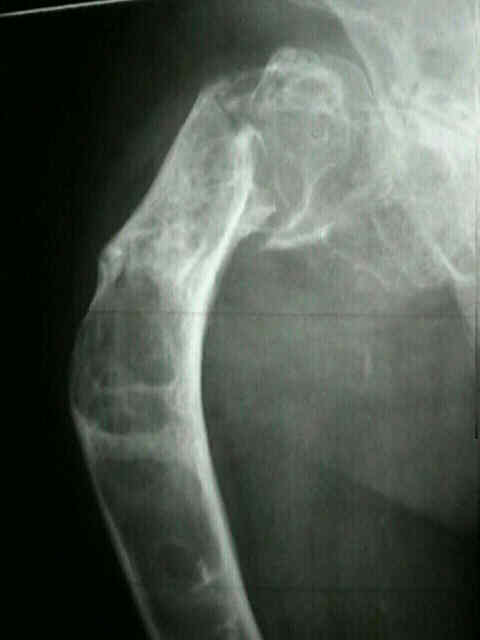 Radiografía de displasia fibrosa en fémur proximal con deformidad en cayado y fractura patológica