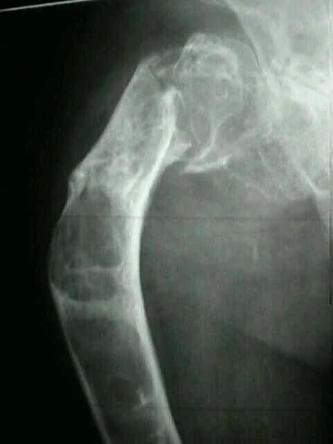 Radiografía de displasia fibrosa en fémur proximal con deformidad en cayado y fractura patológica