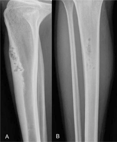 Radiografía de displasia osteofibrosa