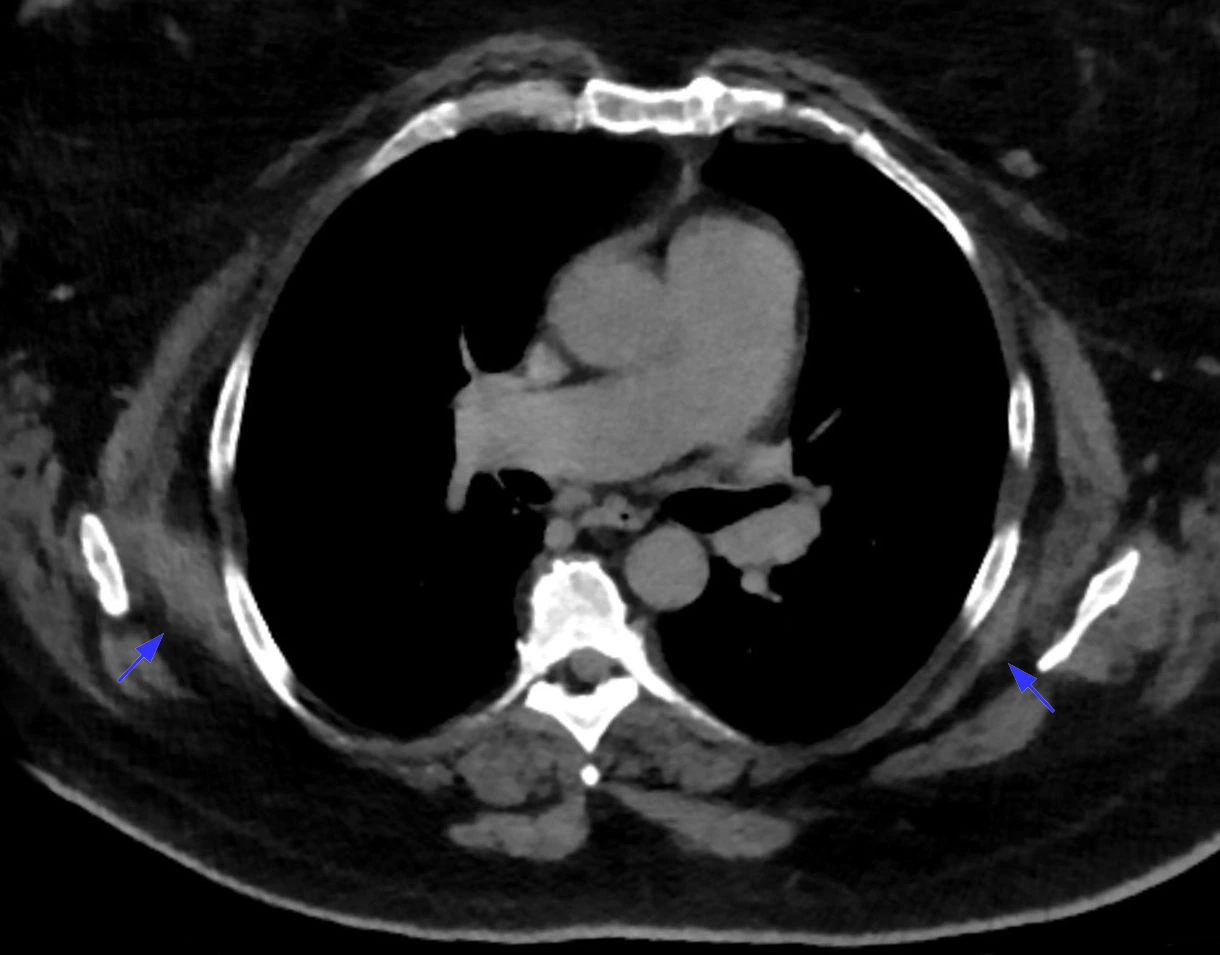 TC axial de elastofibroma dorsi subescapular