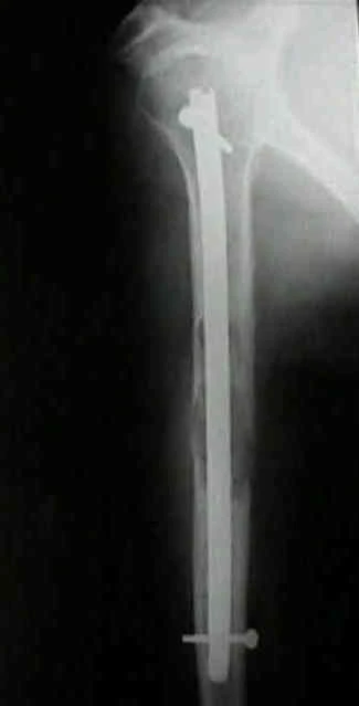 Enclavado endomedular del húmero
