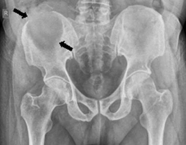 Fibroma condromixoide en radiografía AP de pelvis