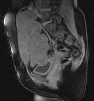 Resonancia magnética de fibromatosis tipo desmoide en pelvis