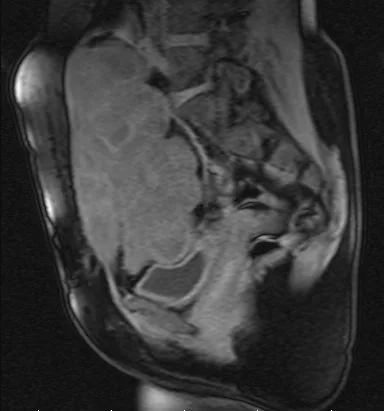 Resonancia magnética de fibromatosis tipo desmoide en pelvis