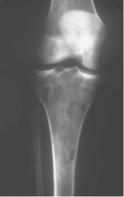 Fibrosarcoma óseo en radiografía AP de tibia