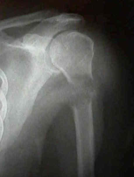 Ejemplo radiográfico de fractura patológica