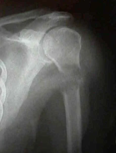 Ejemplo radiográfico de fractura patológica