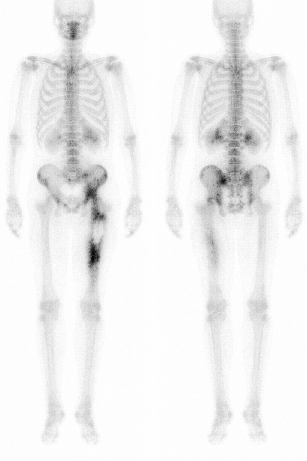 Gammagrafía ósea con captación patológica