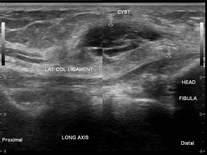 Ganglión en ecografía