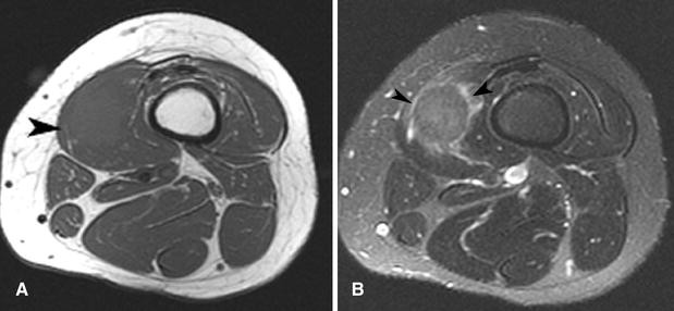 Imagen de tumor de células granulares