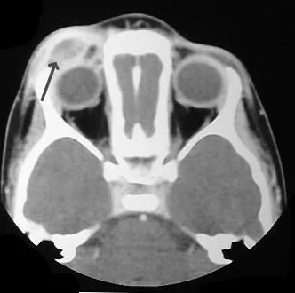 Granuloma eosinófilo en tomografía computarizada