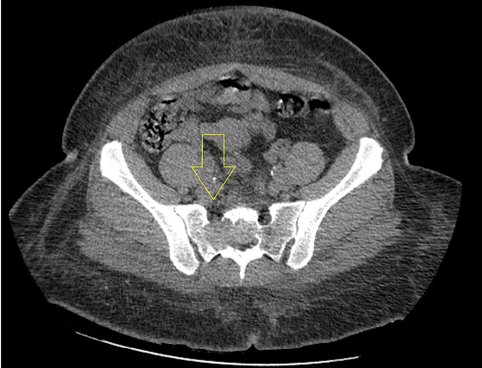 Hemangioma epitelioide óseo en tomografía computarizada