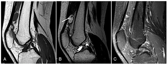 Hemangioma sinovial de rodilla en resonancia magnética