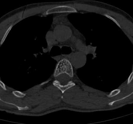 Hemangioma vertebral intraóseo en TC axial con patrón polka-dot