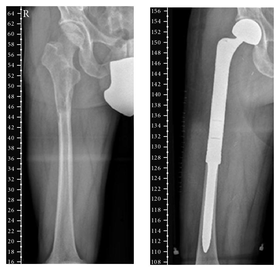 Radiografía preoperatoria de leiomiosarcoma primario de hueso con lesión lítica expansiva en fémur proximal