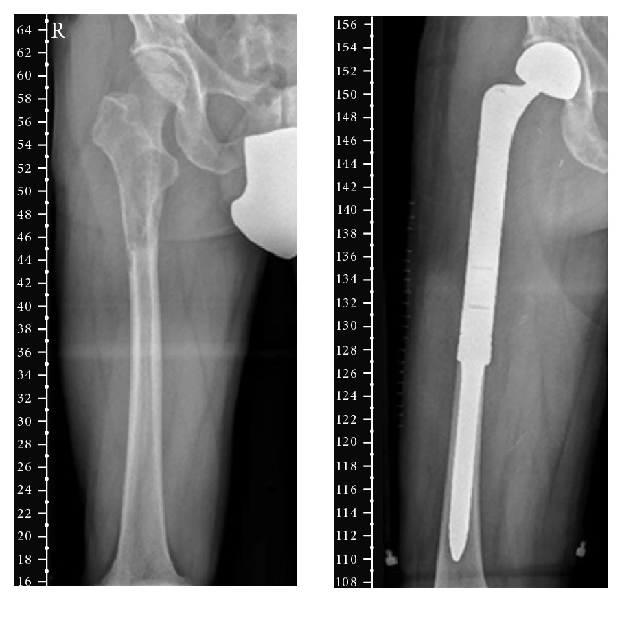 Radiografía preoperatoria de leiomiosarcoma primario de hueso con lesión lítica expansiva en fémur proximal