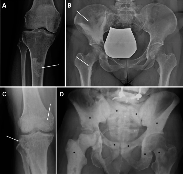 Radiografías de distintas lesiones esclerosas del hueso: infarto óseo, melorreostosis, osteopoiquilosis y metástasis osteoblásticas