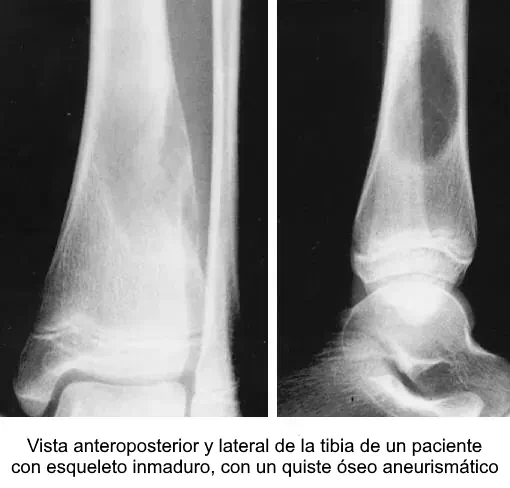 Ejemplo de lesión pseudotumoral ósea