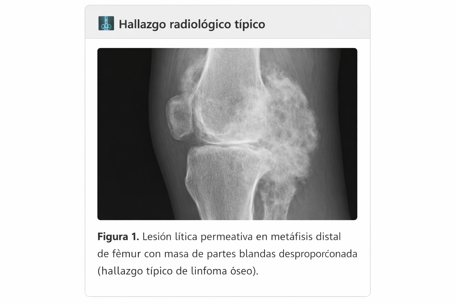 Radiografía/RM de linfoma óseo primario
