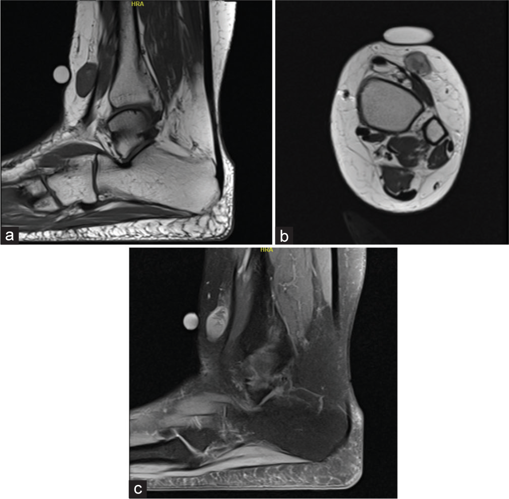 RM de MPNST epitelioide