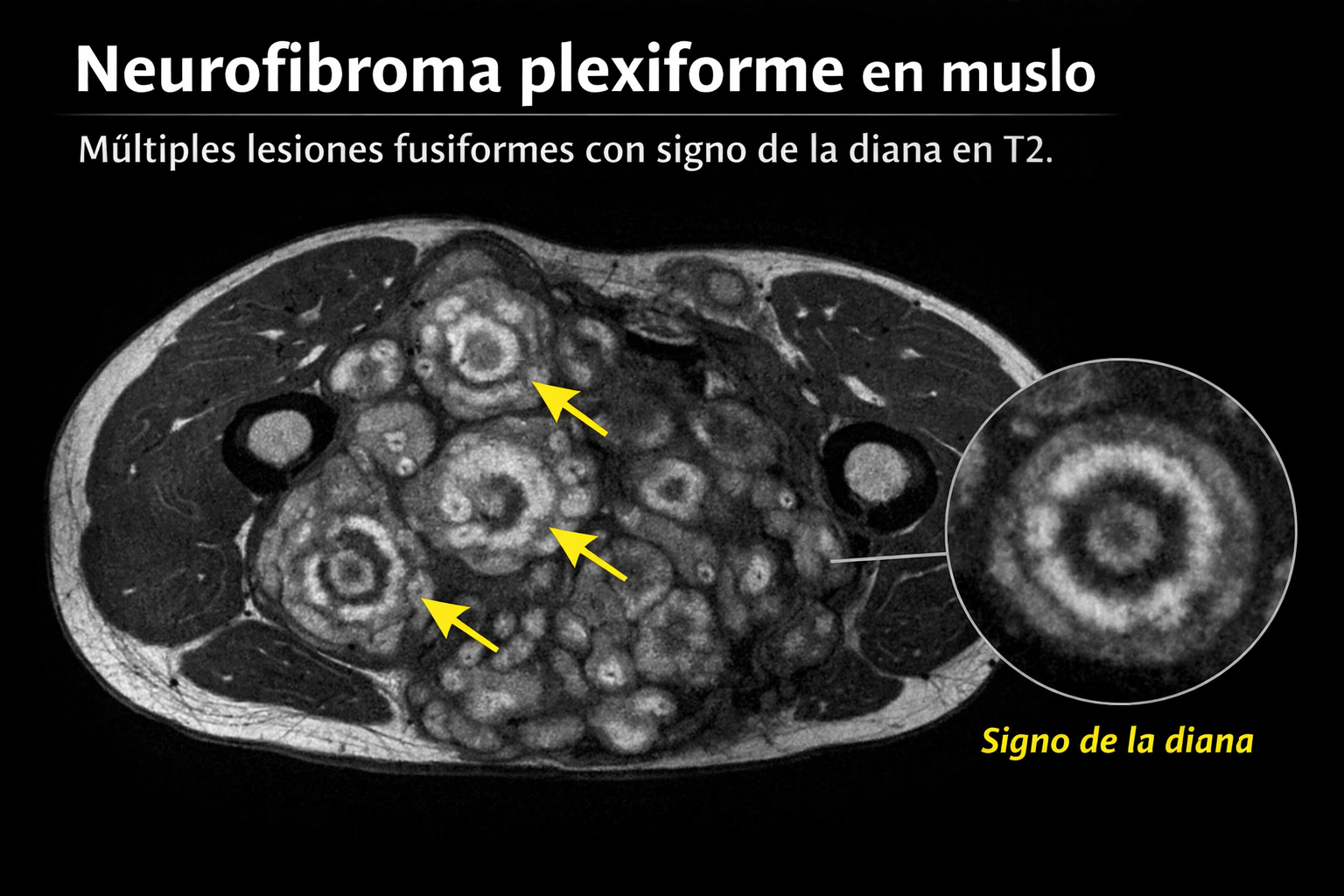 RM de neurofibroma