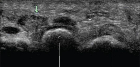 Ecografía de neuroma de Morton