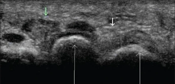 Ecografía de neuroma de Morton
