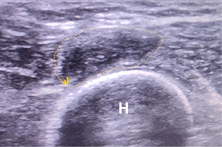 Ecografía de neuroma traumático