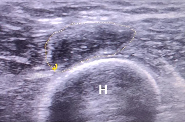 Ecografía de neuroma traumático