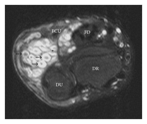 RM de neurofibroma plexiforme en NF1